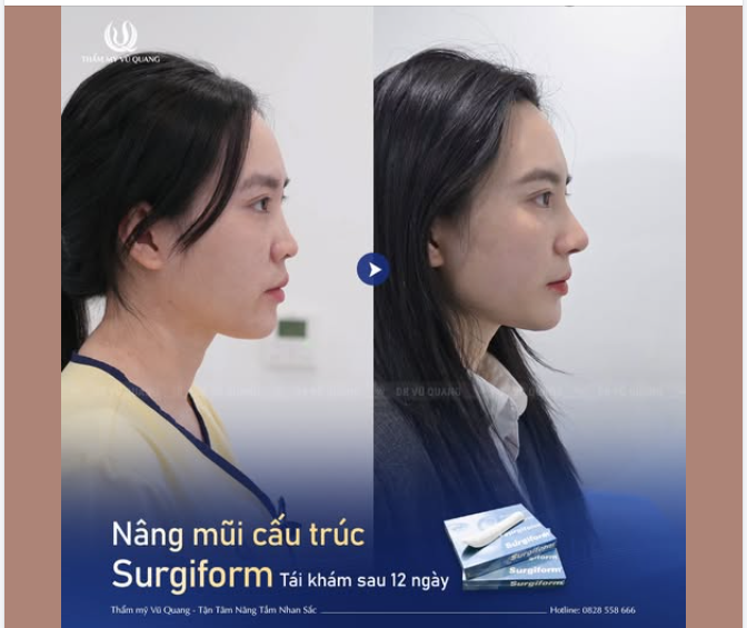 Nâng mũi cấu trúc Surgiform - Tái khám sau 1 tháng
