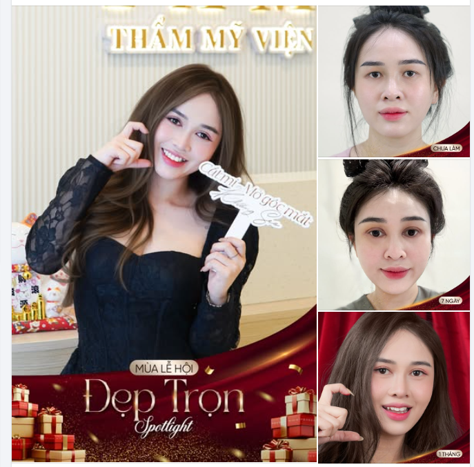 Chị M.T  Dịch vụ: Cắt mí Shanghai – Mở góc mắt trong