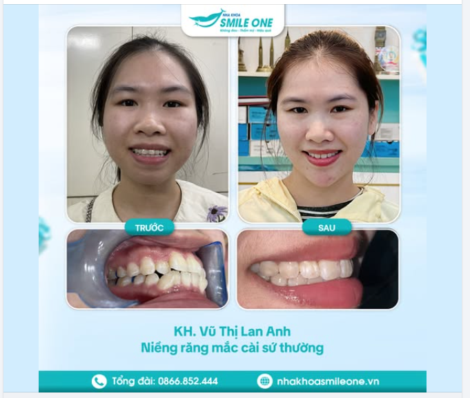 2 năm làm bạn với niềng răng và kết quả nhận lại xứng đáng hơn bao giờ hết của bạn Lan Anh!