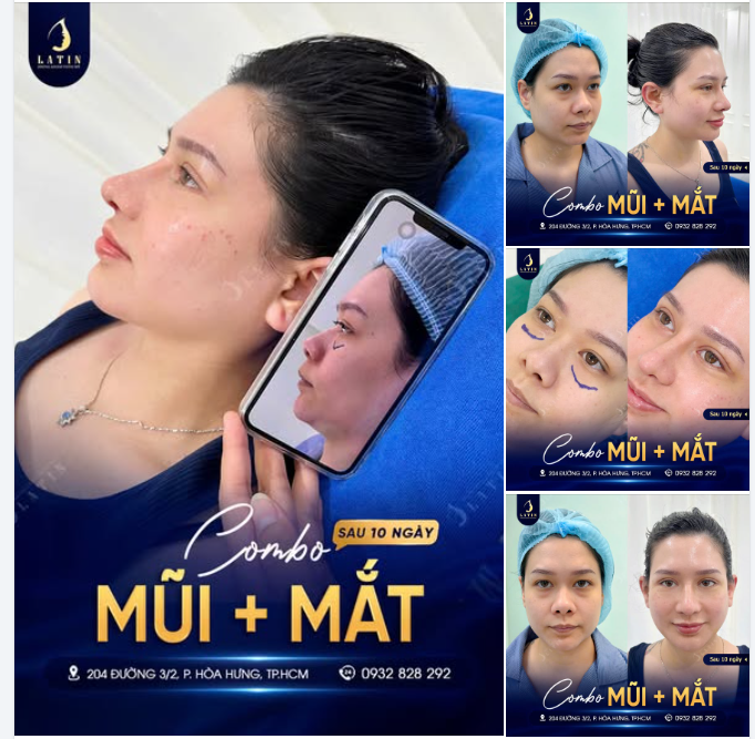 COMBO MŨI VÀ MẮT - HOÀN THIỆN CẢ GƯƠNG MẶT TRƯỚC KHI VỀ NƯỚC