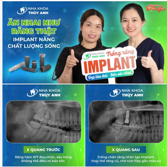 90% THÀNH CÔNG CỦA CA TRỒNG RĂNG IMPLANT ĐẾN TỪ TAY NGHỀ BÁC SĨ