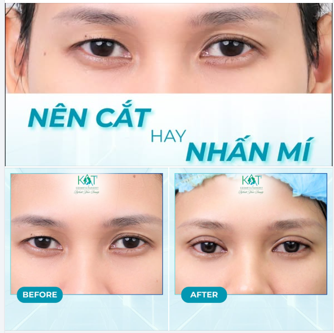 CHỌN CẮT HAY NHẤN MÍ