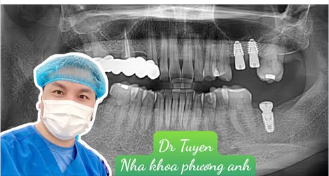 Sau khi cấy ghép implant cần kiêng gì?