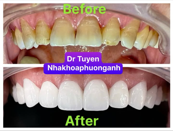 Đối tượng nào nên bọc răng sứ ?