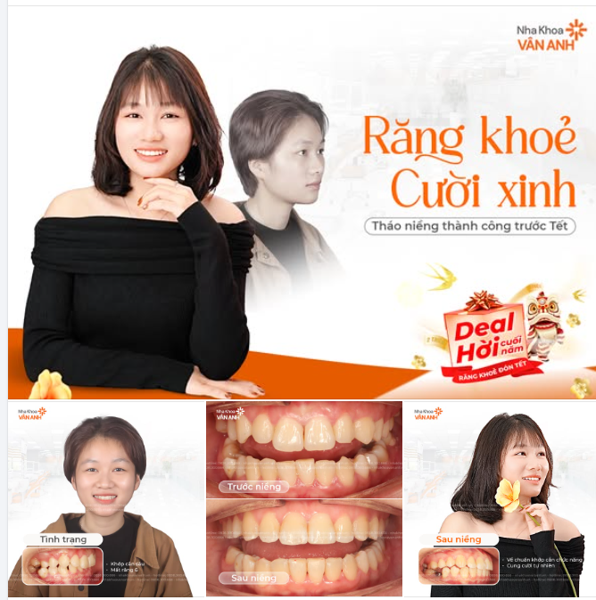 RĂNG KHỎE – CƯỜI XINH. THÁO NIỀNG THÀNH CÔNG TRƯỚC TẾT
