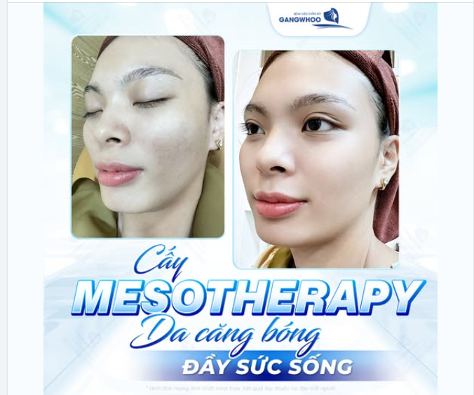 CẤY MESOTHERAPY DA CĂNG BÓNG ĐẦY SỨC SỐNG