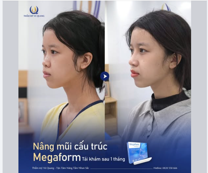 Mũi 1 tháng tuổi, mời cả nhà vào chấm điểm! Đi làm đẹp thế này thì có gọi là thành công không ạ!?