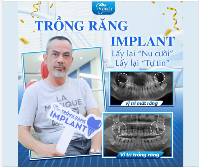 TRỒNG RĂNG IMPLANT: LẤY LẠI NỤ CƯỜI - LẤY LẠI TỰ TIN!