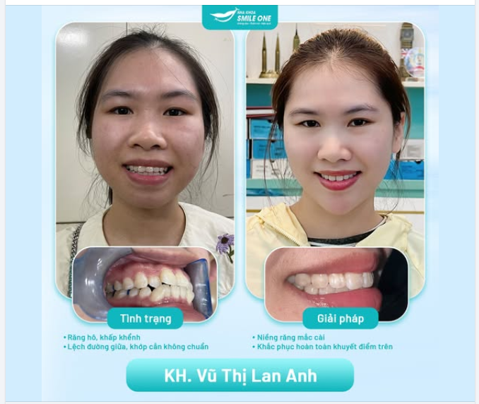 Chưa tới 2 năm niềng răng, đổi lại một nụ cười tươi như nắng và khuôn mặt V-Line không cần phẫu thuật.