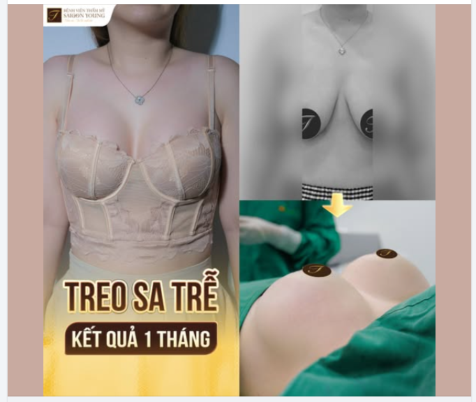 TREO SA TRỄ - TÁI SINH VÒNG 1 CHẢY XỆ