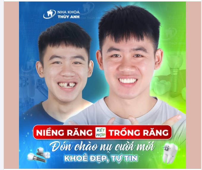 NIỀNG RĂNG KẾT HỢP TRỒNG IMPLANT – CHÀNG TRAI TRẺ KỊP ĐÓN NĂM MỚI VỚI NỤ CƯỜI TRỌN VẸN