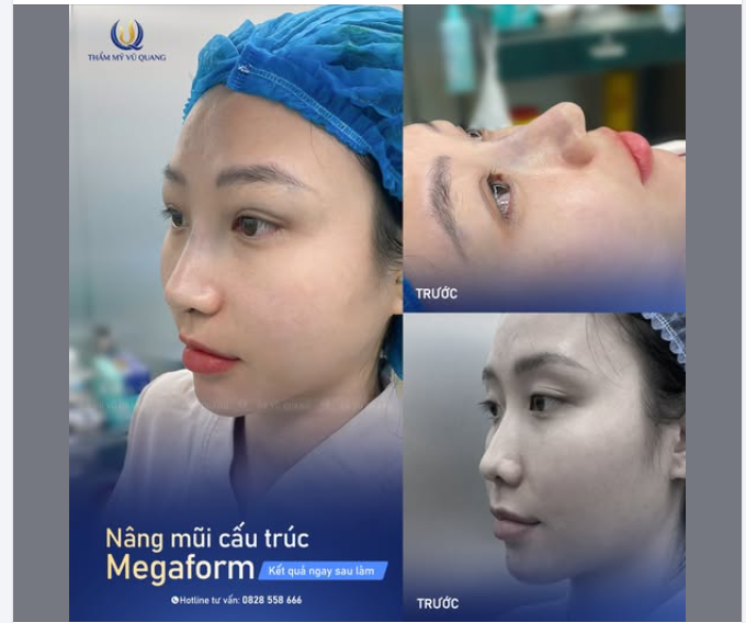 FLEX DÁNG MŨI NGAY SAU LÀM TẠI THẨM MỸ VŨ QUANG