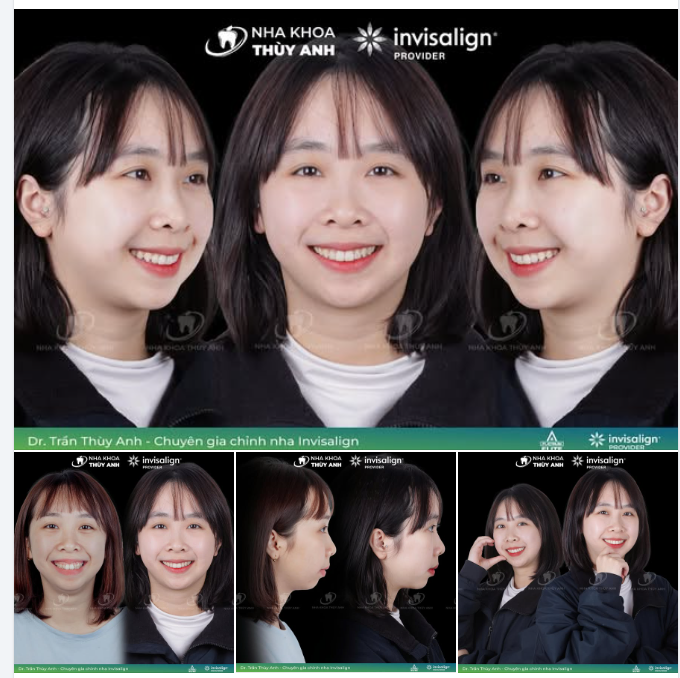 ĐIỀU TRỊ HÔ HÀM TRÊN – LÙI CẰM CẢI THIỆN GÓC NGHIÊNG VỚI INVISALIGN CASE KHÔNG NHỔ RĂNG
