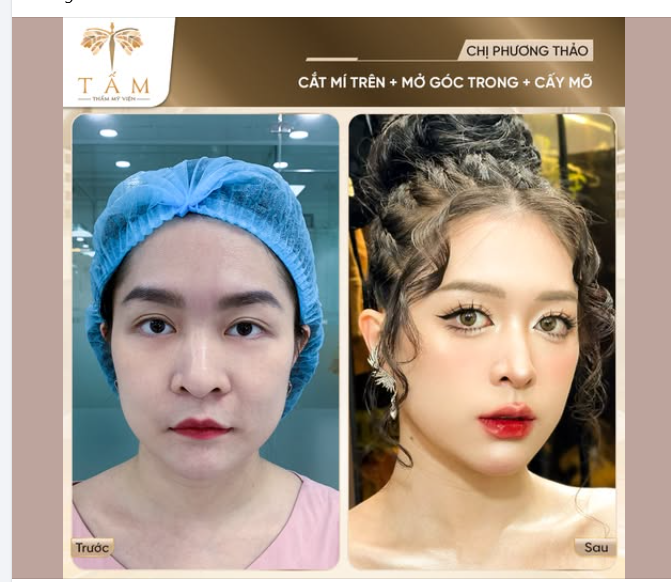 “Mình khá kỹ tính nên mất gần 7 tháng để tìm nơi cắt mí. Làm trên mặt thì an toàn vẫn là ưu tiên hàng đầu. Sau khi đọc review, mình chọn TMV Tấm. Ban đầu cũng lo, nhưng nhìn kết quả hiện tại thì biết là mình đã chọn đúng.” - Chị Phương Thảo chia sẻ C