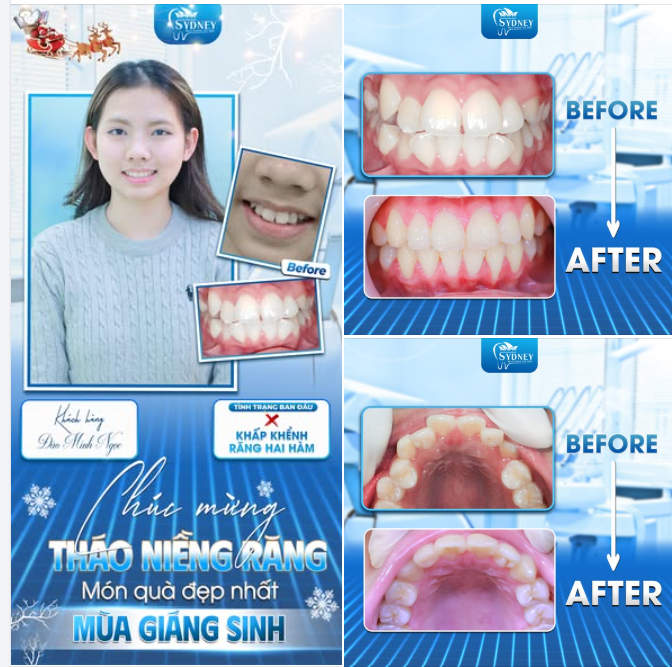 THÁO NIỀNG RĂNG - MÓN QUÀ ĐẸP NHẤT MÙA GIÁNG SINH