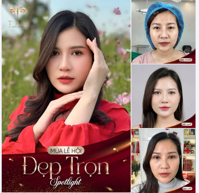 Chị N.P  Dịch vụ: Cắt mí trên + Mở góc trong