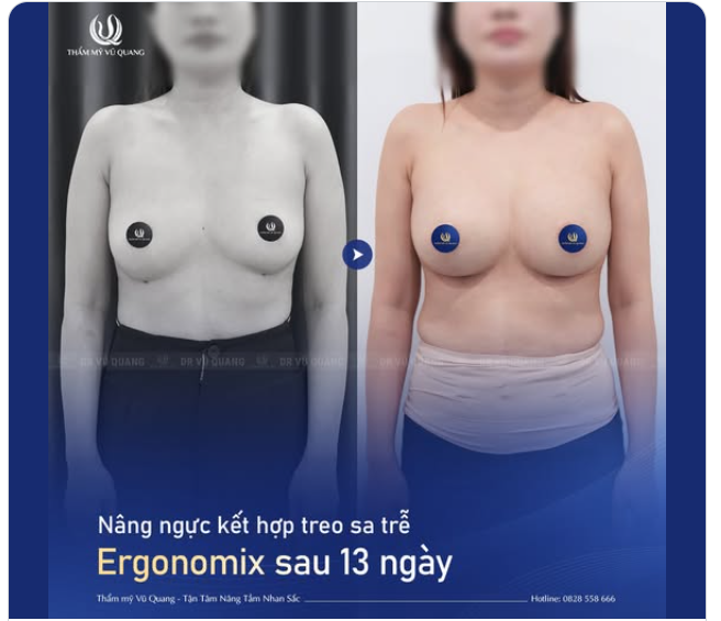 VÒNG 1 SAU SINH 1 BÉ CÓ NÂNG ĐƯỢC KHÔNG?
