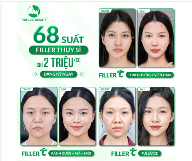 Tặng Nàng 68 Suất Filler Thụy Sĩ Chỉ 2 Triệu/CC