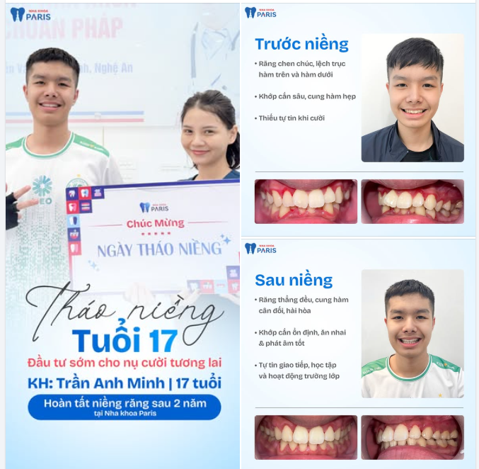 17 TUỔI THÁO NIỀNG – ĐẦU TƯ SỚM CHO NỤ CƯỜI TƯƠNG LAI!