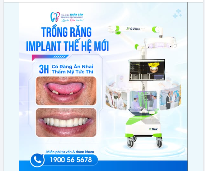 TRỒNG RĂNG IMPLANT THẾ HỆ MỚI  3H CÓ RĂNG ĂN NHAI, THẨM MỸ TỨC THÌ