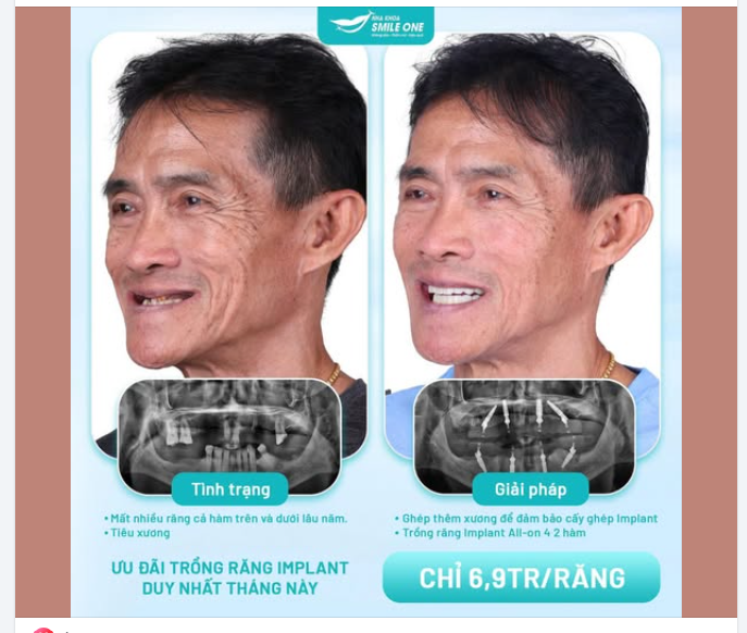 Hậu quả của mấy tăng lâu ngày nhưng không khôi phục kịp thời là:  - Tiêu xương nhiều  - Tụt lợi trầm trọng dẫn đến các răng bên cạnh bị ảnh hưởng, lâu dần lung lay và rơi rụng