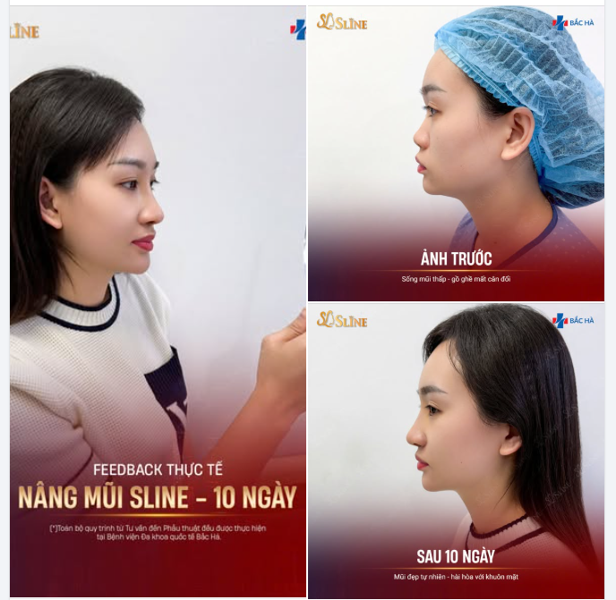 “Không nghĩ là chỉ thay đổi một điểm… mà gương mặt mình lại hài hòa đến vậy.”