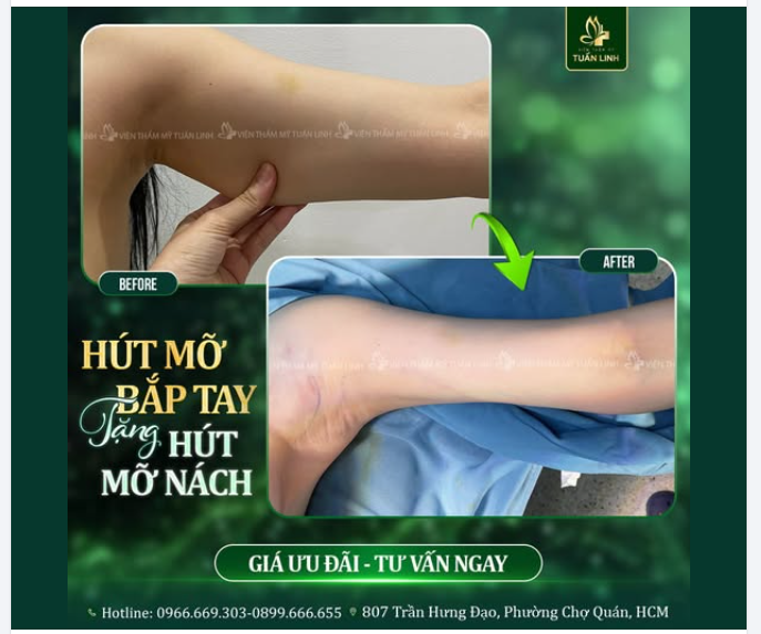 HÚT MỠ BẮP TAY – TẶNG NGAY HÚT MỠ NÁCH