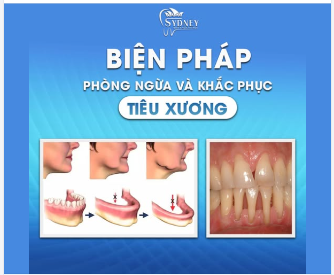 BIỆN PHÁP PHÒNG NGỪA  KHẮC PHỤC TIÊU XƯƠNG