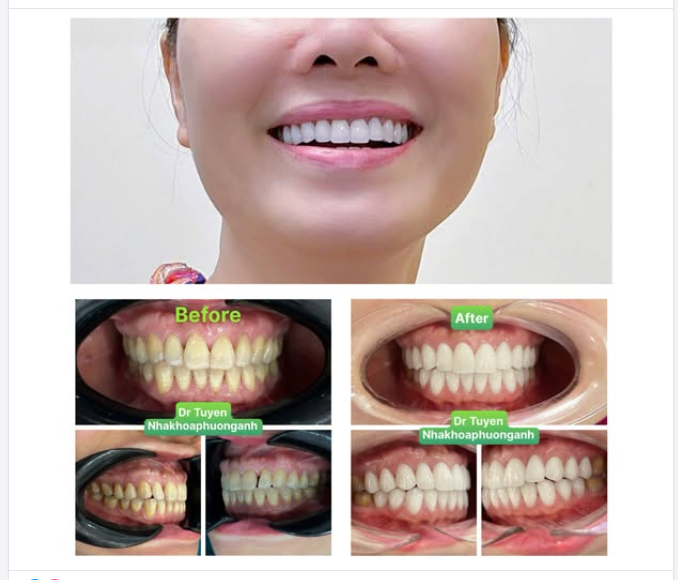 Những lưu ý sau khi làm răng sứ thẩm mỹ