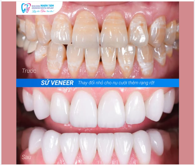 Một thay đổi rất nhỏ… nhưng đủ để bạn mỉm cười tự tin mỗi ngày.