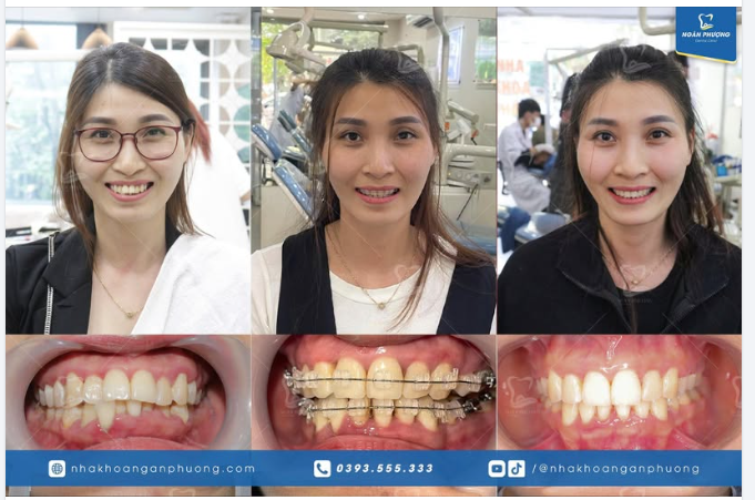 Tuổi nào niềng răng vẫn là không quá muộn