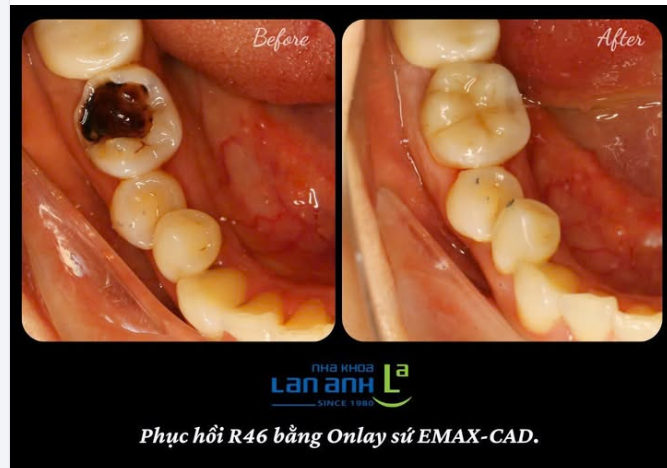 Bạn có răng bị bể vỡ lớn mà chưa xử lý?