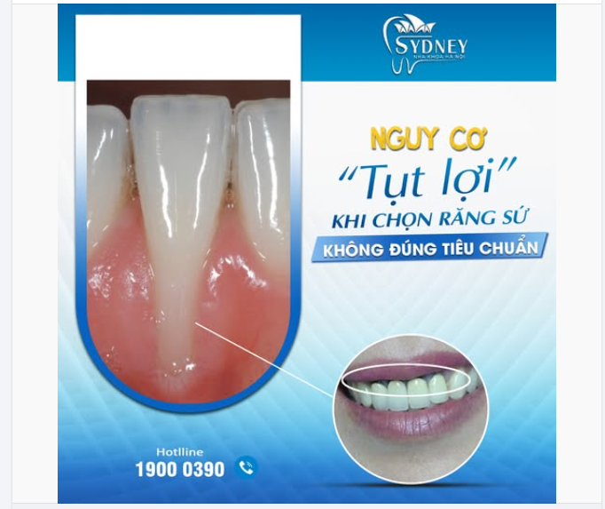 Đừng để nụ cười đẹp “tạm thời” đánh đổi bằng sức khỏe răng miệng lâu dài. Nếu có dấu hiệu ê buốt, đen viền lợi, tụt lợi sau bọc sứ - Hãy đi thăm khám sớm để được xử lý kịp thời!