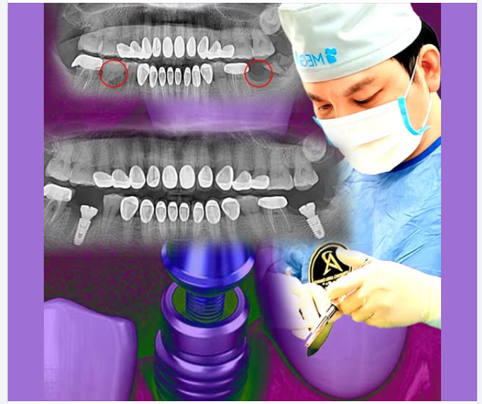 9 lợi ích của việc cấy ghép Implant