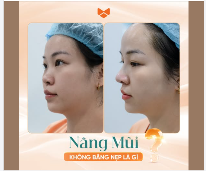 NÂNG MŨI KHÔNG BĂNG NẸP LÀ GÌ?