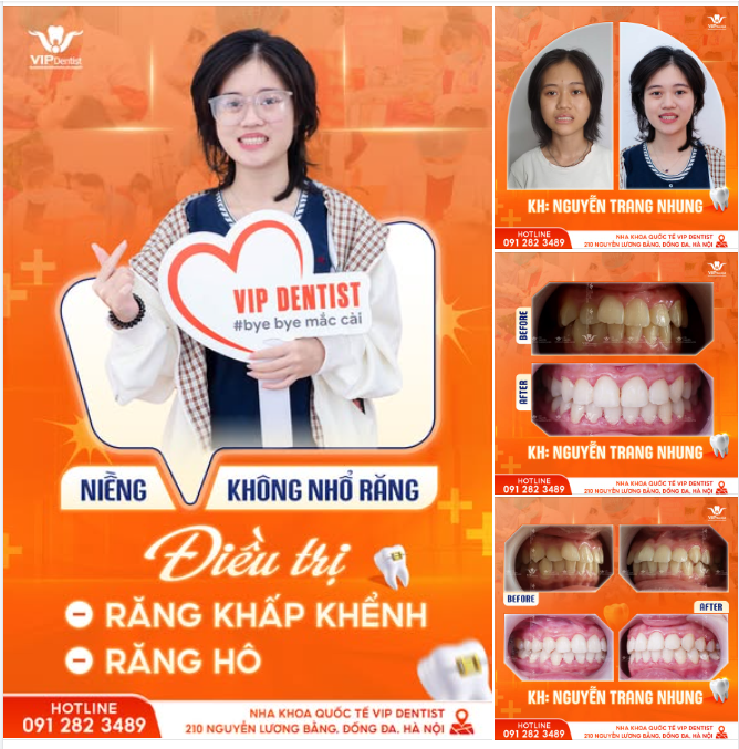 THÀNH QUẢ NGỌT NGÀO SAU HÀNH TRÌNH NIỀNG RĂNG KHÔNG NHỔ RĂNG