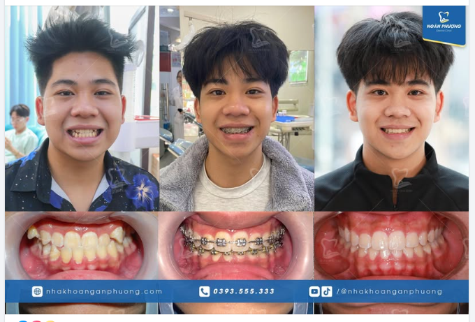 Niềng răng mà đẹp như tài tử Hong Kong thế có chớt không cơ chứ?