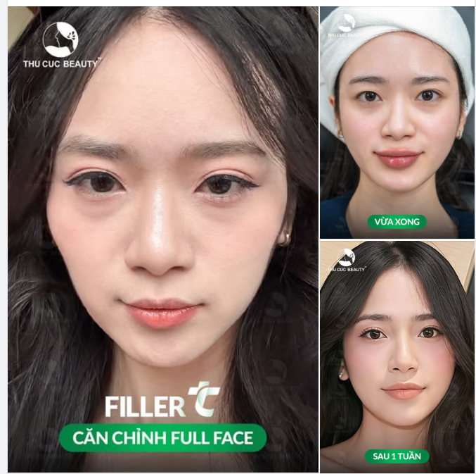 Mặt hốc hác như "yên xe đạp"?  Chọn tiêm filler tại Thu Cúc: