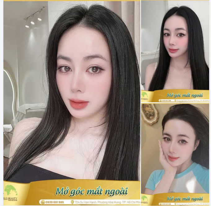 Mở góc mắt ngoài - Thay đổi nhỏ nhưng khác biệt lớn đến sự hài hòa cho tổng thể gương mặt.