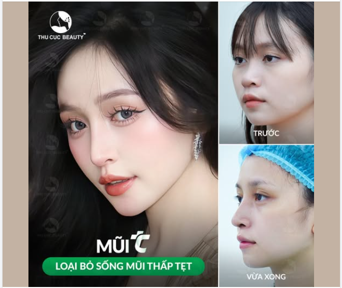 Tự ti chẳng dám chụp góc nghiêng vì sống mũi thấp tẹt Chọn ngay Mũi TC