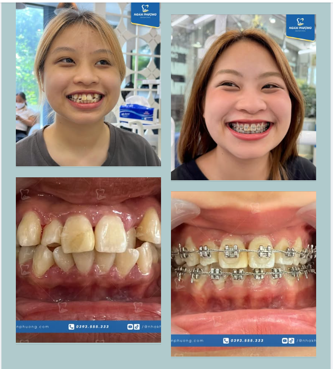 Nụ cười tỏa nắng hơn cả mùa thu Hà Nội, niềng răng tươi cỡ này, đồng niềng sẵn sàng chưa?