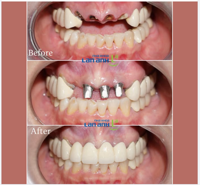 Răng sứ làm ở nơi khác, bị vênh, bị hở, dùng một thời gian là răng bị mục rồi phải nhổ và thay bằng Implant ạ…