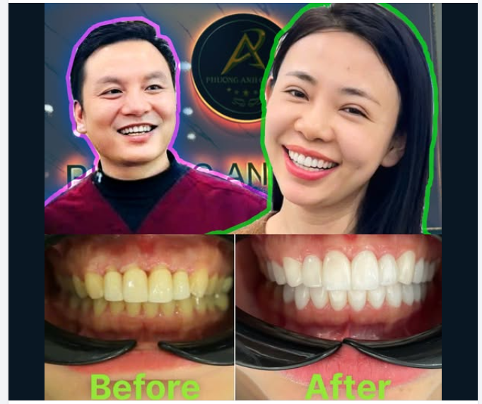 Cách Chăm Sóc Để Răng Sứ Tồn Tại Lâu Dài Hơn