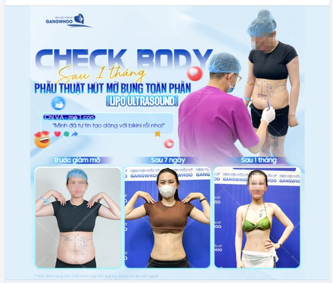 CHECK BODY SAU 1 THÁNG  Phẫu thuật hút mỡ bụng toàn phần (Lipo Ultrasound)