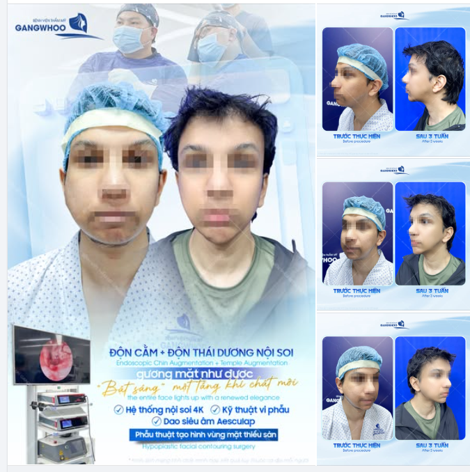 ĐỘN CẰM + ĐỘN THÁI DƯƠNG NỘI SOI – KHI GƯƠNG MẶT NAM GIỚI “SÁNG” LÊN CHỈ BẰNG HAI ĐIỂM TINH CHỈNH