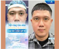 Nếu bạn đang gặp tình trạng mí sụp ảnh hưởng đến thẩm mỹ hoặc tầm nhìn, đừng ngại để bác sĩ tại BVTM Gangwhoo tư vấn giải pháp phù hợp nhất cho bạn