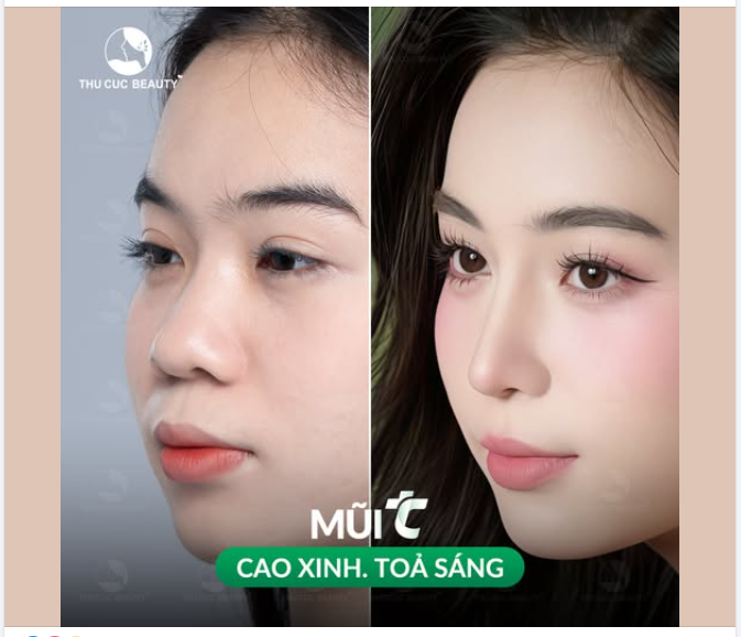 Dáng mũi "không góc chết" sau 1 tháng phẫu thuật
