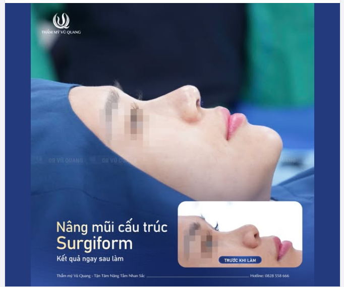 Nếu được đổi 45 phút lấy dáng mũi cao bay này, chị em có muốn đổi không ạ?