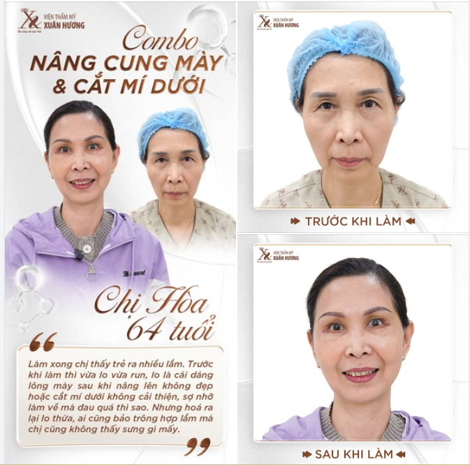 COMBO NÂNG CUNG MÀY KẾT HỢP CẮT MÍ DƯỚI - LẤY LẠI VẺ RẠNG RỠ CHO KHUÔN MẶT