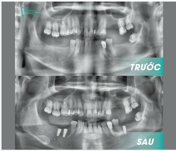 Bác Minh – 65 tuổi – vừa hoàn thành bước đầu quan trọng trong hành trình lấy lại khả năng ăn nhai tại Nha khoa Sentosa.